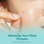 Femisafe Acne Pimple Patch: 72 Invisible, Waterproof Hydrocolloid Patches with 2% Salicylic Acid for Overnight Pus Reduction - Effective Spot Treatment for Active Surface Acne for Men & Women - Fast UK Delivery - Image 6